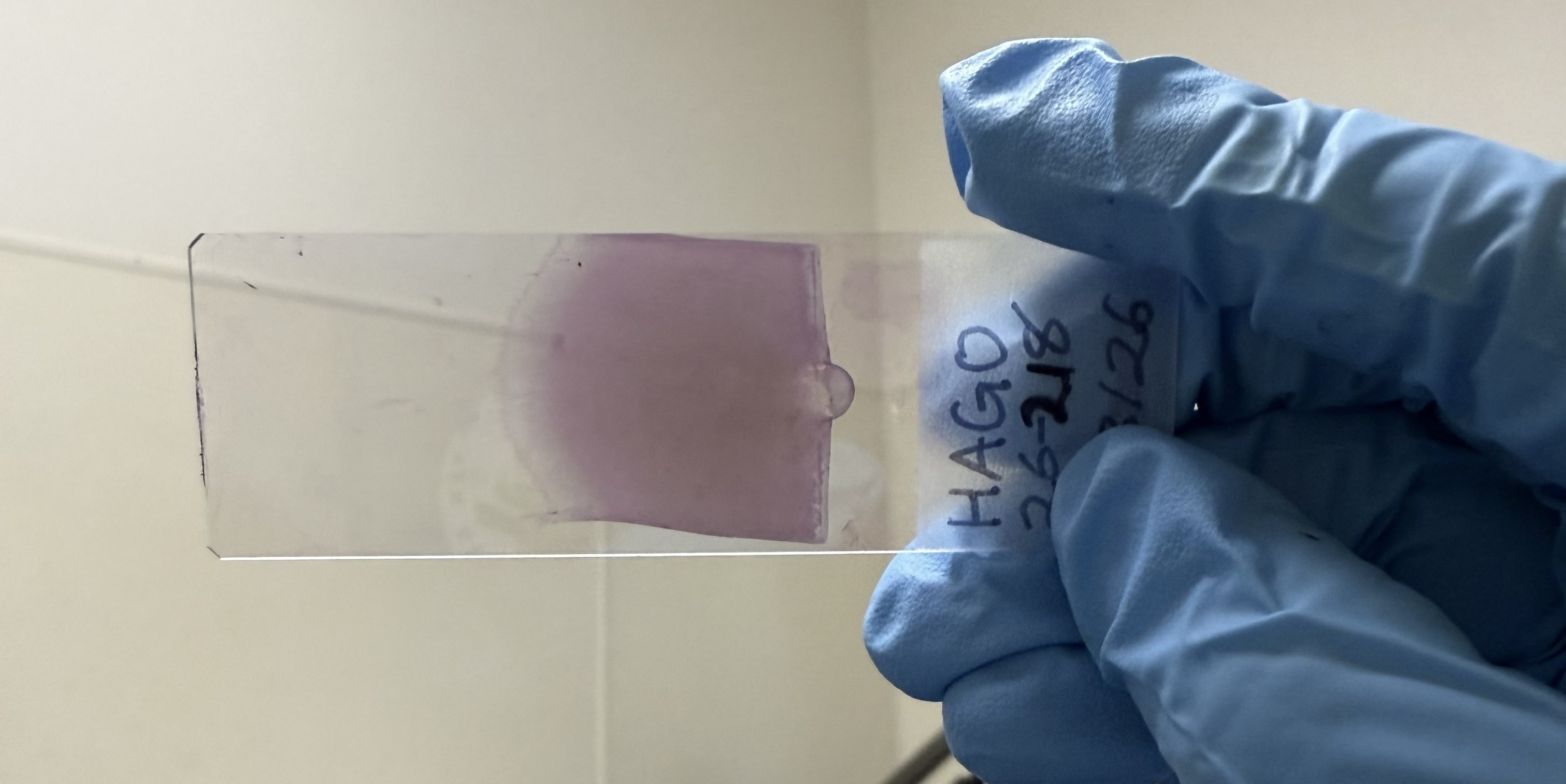 A close up of a blood smear on a glass slide being held up by a blue-gloved hand.